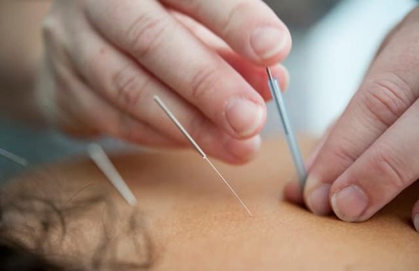 Can Regular Facial Acupuncture Improve Skin Elasticity and Reduce Signs of Aging?